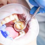 dental filling procedure for tooth decay treatment